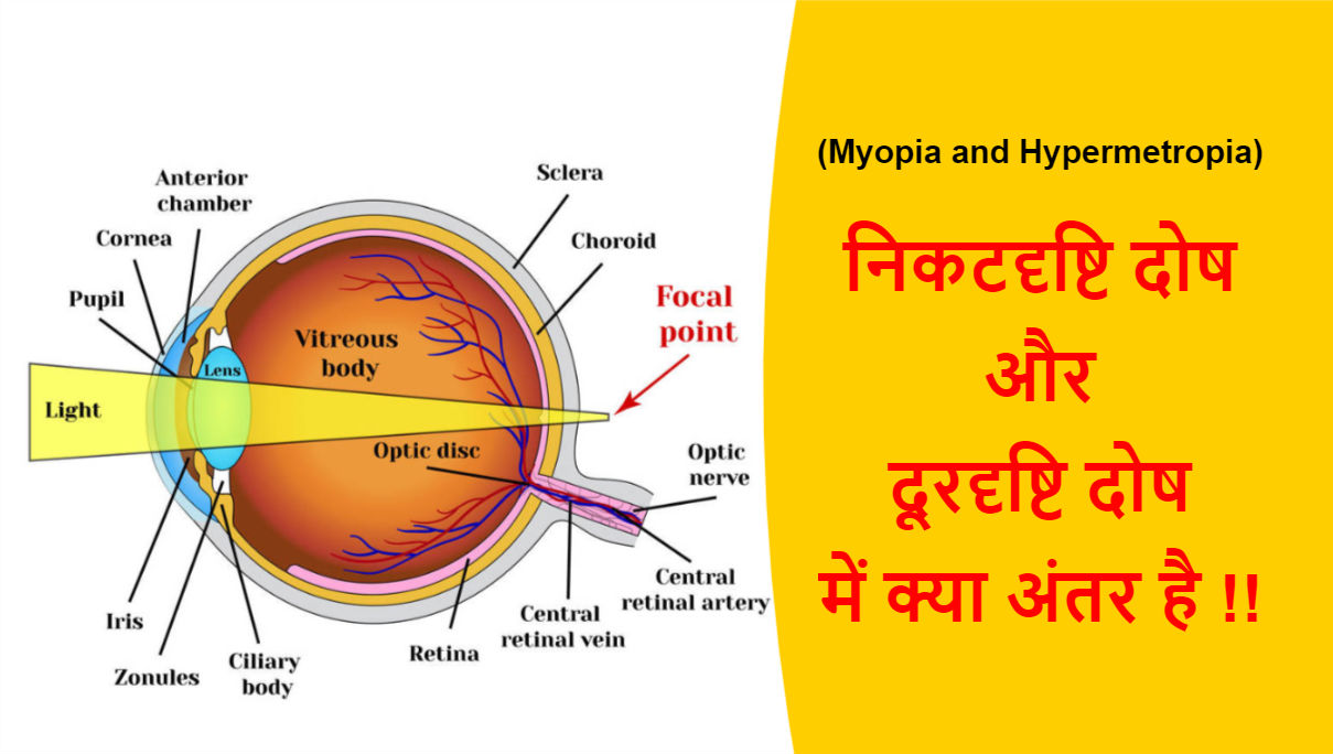 Read more about the article (Myopia & Hypermetropia) निकटदृष्टि दोष और दूरदृष्टि दोष में क्या अंतर है !!